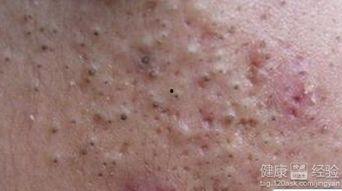 疥疮可以吃哈密瓜