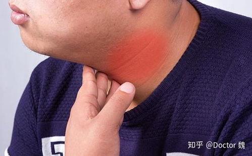 甲状腺吃角瓜吗